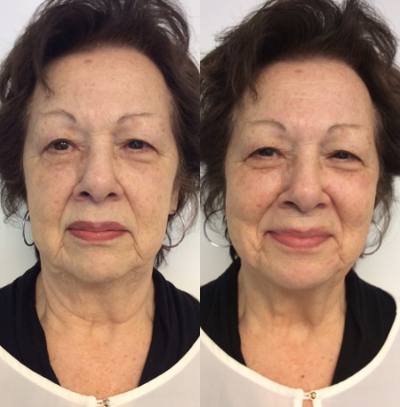 65-74 year old woman treated with HydraFacial - HydraFacial is an amazing treatment for immediately plump, soft skin with no downtime.