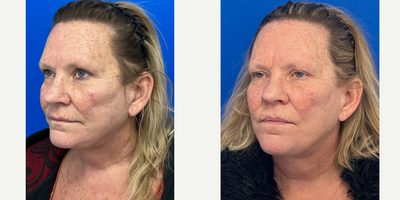 55-64 year old woman treated with CO2 Laser - 57 year old patient treated with 2 sessions of CO2 laser skin resurfacing.