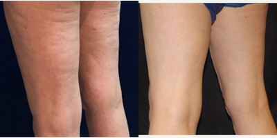 45-54 year old woman treated with Evolve - This patient was treated with Evolve Tite to tighten the skin on the backs of her legs. This treatment left her with an improvement in cellulite and nicely tightened the area.