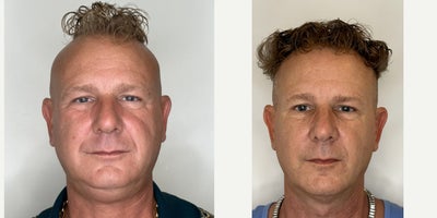 45-54 year old man treated with Hair Loss Treatment, Microneedling RF - Along with more than 40 pounds weight loss in 12 months, started our signature Triple Glow lift to maintain the skin tone and texture and avoid sagging in lower face along with our hair loss treatment with Laser and DeRive Exosome.
