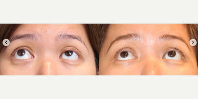 Woman treated with Eyelid Surgery, Double Eyelid Surgery, Ptosis Surgery - Left upper eyelid ptosis and double-fold correctionThis lovely lady underwent surgical correction of her long-term droopy eyelid problem in the left upper eyelid, she also had a very unstable double eyelid fold that we helped to reset in place.You can see the more symmetrical eyes and the improved appearance! Eyelid Surgery can be life-changing!