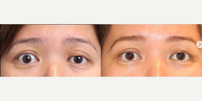 Woman treated with Eyelid Surgery, Double Eyelid Surgery, Ptosis Surgery - Left upper eyelid ptosis and double-fold correctionThis lovely lady underwent surgical correction of her long-term droopy eyelid problem in the left upper eyelid, she also had a very unstable double eyelid fold that we helped to reset in place.You can see the more symmetrical eyes and the improved appearance! Eyelid Surgery can be life-changing!