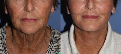 face lift with laser resurfacing, 67 year old - This 67 year old comes to see us because she is unhappy with her aged appearance. She dislikes her jowls and neck as well as the uneven tone and texture of her skin. She had a face lift and laser resurfacing.