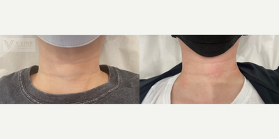 35-44 year old woman treated with NovaThreads - 35-44 year old woman treated with NovaThreads