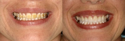 Developmental Discoloration - This young lady had stains on her teeth since birth.&nbsp; The well water that she was raised on had a high mineral content that affected her teeth.After 10 veneers a more natural, healthy and beautiful smile emerged!
