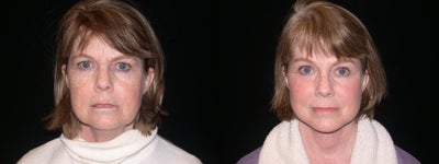 Brow Lift - 
	Brow Lift
