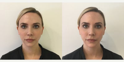 35-44 year old woman treated with Chin Filler - This is a subtle chin augmentation with one syringe of Restylane Lyft for facial balancing and proportion optimization.