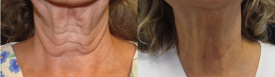 Woman treated with Exilis - Woman treated with Exilis