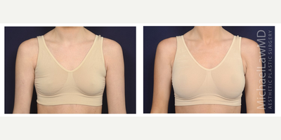 25-34 year old woman treated with Ideal Implant - Breast augmentation. Follow-up photo taken 3 months after the procedure.