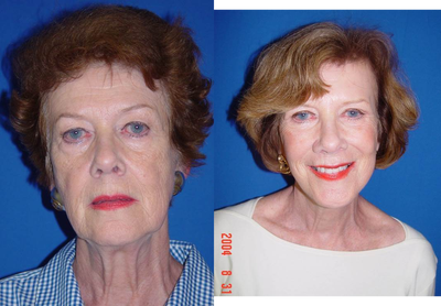 Facial Rejuvenation Before and After - Facial rejuvenation by Dr. Stefan&nbsp;