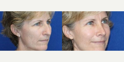 Woman treated with Eyelid Surgery - Woman treated with Eyelid Surgery