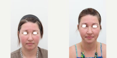 35-44 year old woman treated with AccuLift, Liposuction, Laser Liposuction - Chief Complain: Bulky cheeks, face always looks swelled, face assymetry, double chin, chubby cheeksTreatment Plan: face liposuction (double chin, cheek bone, cheeks)Outcome: face shape balance, reduce exessive fat, more V-lined shape