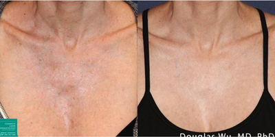 Woman treated with Vbeam - PicoWay, Resolve, and Vbeam lasers used to treat sun damage on chest by Dr. Wu