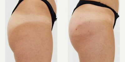 SculpSure - Sculptra Butt-Lift by Dr. Marciano
