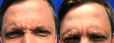 25-34 year old man treated with Botox - Botox injection in the forehead and between the brows to reduce wrinkles.