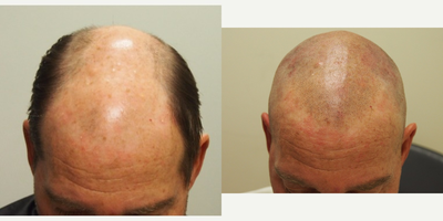 55-64 year old man treated with Scalp Micropigmentation - 55-64 year old man treated with Scalp Micropigmentation wanted a very subtle shaved look