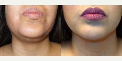 Woman treated with Chin Liposuction - Liposuction of the chin is a great solution for those who are looking to reduce submental fullness (aka double chin) and create more definition to their jaw. It is a minimally invasive procedure that involves the use of local anesthetic to numb the chin and neck area. A small incision is made underneath the chin, that allows me to insert the liposuction cannula. From there I remove the excess fat and many times incorporate Renuvion Plasma Lipo leaving patients with a tighter, more youthful chin and neck area.