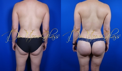 BUTT Implants with Fat Transfer - Butt augmentation with implants, Liposuction, Fat Transfer.