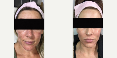 25-34 year old woman treated with Aquagold - AQUAGOLD, a first of its kind, microchannel microinjector. Designed to effectively microinject a custom cocktail of therapeutics under the dermis, at a consistent depth. Looking for skin so smooth it looks like glass? This is it!Dr. Walter will consult with you and guide you to the most effective therapeutics for your skin type. Botox, dermal fillers, Retinol, Vitamin C, or growth factors are microinjected into the dermis while stimulating collagen and elastin production. Results are visible almost instantly with no downtime.This deeper penetration of the active ingredient results in a more healthy, vibrant appearance of the skin.  Aqua Gold can be used to treat problem areas anywhere on the face and body or can be hyper-focused to gently treat hard-to-reach areas like lips and eyes.