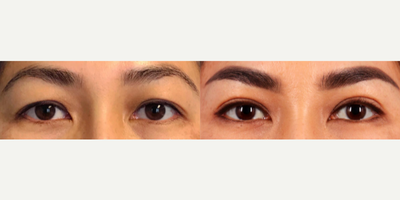 25-34 year old woman treated with Double Eyelid Surgery - Upper Blepharoplasty before and after, frontal