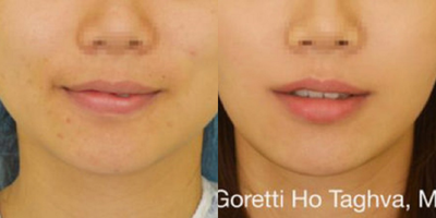 Woman treated with Buccal Fat Removal - Buccal fat removal and botox to masseter muscles for facial slimming