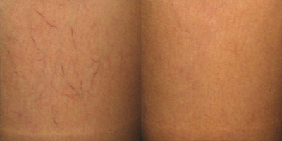 Asclera - 
	Pre and Post Asclera Treatment
