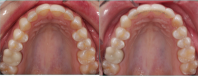 35-44 year old woman treated with Lingual Braces - Lingual braces placed on the inside of the upper teeth to correct the position of the right front tooth.