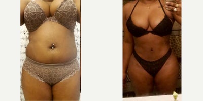 25-34 year old woman treated with Liposuction - 25-34 year old woman treated with abdomen, waist, flanks, armpits, upper and lower back Liposuction + DBL