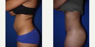 Tummy Tuck - Mother of one, who had her muscles ruined by pregnancy. They did not shrink back to normal. Pt just wanted to feel more normal again. pt was unhappy with all the stretch marks as well. Pt got a tummy tuck.