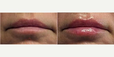 45-54 year old woman treated with Lip Fillers, Juvederm, Volbella, Restylane, Restylane Kysse - Lip augmentation with hyaluronic acid filler (Juvederm, Vollure, Volbella, Voluma, Restylane or Belotero) for balanced natural look & pout