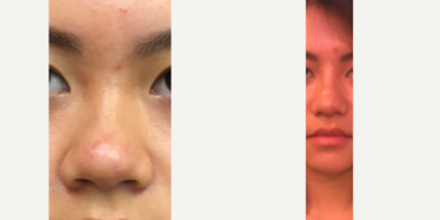 18-24 year old woman treated with Rhinoplasty - Non-Caucasian Rhinoplasty; Cartilage Graft from Ear to Columella; Wedges; Large Dorsal Shirakabe Implant