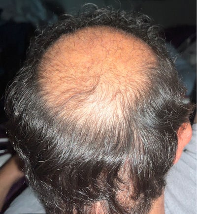 1/6 Joe ヘッド with Hair Implantation Magneto - (8000+ BH and 869 scalp FUSE grafts) update - Hair