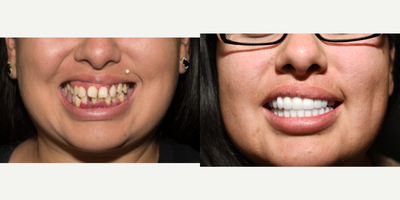 25-34 year old woman treated with All on 4 Dental Implants - All on 4 dental implants restored using Xircon Ultra- Ultimate