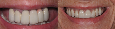 55-64 year old woman treated with ClearChoice Dental Implants - Upper Screw in Full arch teeth