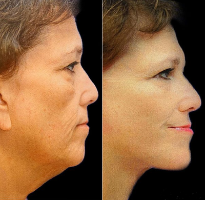 55-64 year old woman treated with Lower Facelift - This patient is 57 and lost 128 lbs from weight loss surgery. She was unhappy with the lower part of her face. She underwent a facelift.