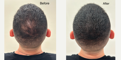 35-44 year old man treated with Scalp Micropigmentation - 41 year old male 4 months after SMP.