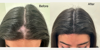 25-34 year old woman treated with Scalp Micropigmentation - 28 year old female 2 months after SMP.
