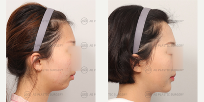 25-34 year old woman treated with Genioplasty, V Line Surgery, Rhinoplasty, Asian Rhinoplasty - V-Line Surgery, GenioplastyRhinoplasty (Nose Ridge+Nose Tip+Hump Correction+Osteotomy)