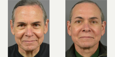 65-74 year old man treated with Mini Lift - Patient presented concerns regarding his neck. His neck concerns consisted of excess skin, sagging skin and turkey neck.  Examination revealed an acute neck/jaw angle.  There was moderate platysmal banding bilaterally at rest with no preplatysmal, preplatysmal or subplatysmal fat.  Moderate skin excess of the neck and moderate cervical skin laxity present.  There was also moderate jowl ptosis.An EZ- Lift Plus - Mini Facelift was recommended.  Seen in post-op at almost 1 year, the patient has no complaints and is pleased with his results.  Exam shows well healed scars and good facial contours.