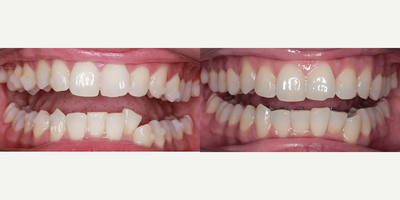 35-44 year old woman treated with Lingual Braces - 35-44 year old woman treated with Lingual Braces.