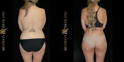 25-34 year old woman treated with Breast Implant Revision, Tummy Tuck, Liposuction, Mommy Makeover - A 2534-year-old woman who underwent a comprehensive Mommy Makeover, including breast implant revision, tummy tuck, and liposuction. The procedures addressed previous implant concerns, restored abdominal tone, and refined body contours, resulting in a rejuvenated, balanced, and natural-looking silhouette that enhances overall body proportion and confidence.