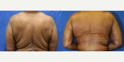 35-44 year old woman treated with Back Lift - This patient was unhappy with the folds on her back. She underwent an upper body lift (also known as a horizontal torsoplasty). Notice how flat her back looks now. She is very happy with her results.