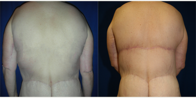 45-54 year old woman treated with Back Lift - This female patient was unhappy with the excess skin and fat on her back. She underwent a horizontal torsoplasty or upper back lift with Dr. J. Timothy Katzen.