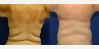 35-44 year old woman treated with Back Lift - This patient had weight loss surgery and lost a large amount of weight. She was not happy with the excess skin and fat on her back. She traveled from San Diego to Beverly Hills to have a horizontal torsoplasty with Dr J Timothy Katzen. She was so happy with her results and care that she sent her husband to have surgery with Dr. Katzen as well.