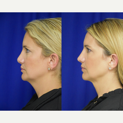 35-44 year old woman treated with Revision Rhinoplasty - Rhinoplasty Revision