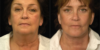 Facelift New York City - This 59-year-old woman wanted complete facial rejuvenation. I performed a full facelift, including the lower face. I also performed a neck lift and upper and lower eyelid surgery.  

Having completed trials for multiple different methods of facelift procedures, I have settled on performing a full SMAS elevation and advancement through an incision that is located around and inside the ear as opposed to in front of the ear. In my hands, this technique seems to come out the most natural-appearing and last the longest. Even when I perform my version of the short-scar facelift, I still treat the underlying tissues the same way. It just makes sense to me that by placing the underlying architecture back where it was when the patient was 25, the rest of the facial features look more natural and youthful. In this way, I am able to avoid pulling the skin too tight or creating a clown appearance.

Patient Age: 59

Procedures Performed:
SMAS facelift
Upper and lower eyelid blepharoplasty

Anesthesia: 
General anesthesia

Recovery:
10 days