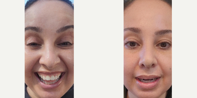 Woman treated with Septoplasty  - Woman treated with Rhinoplasty and Septoplasty for turbinate reduction and correction of deviated septum to enhance her nasal features and to breath comfortably.