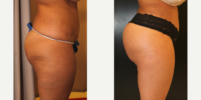 Butt Augmentation - Butt Augmentation