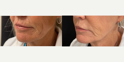 61 year old woman treated with Agnes RF - 61 year old woman treated with Agnes RF to lower face. 1 of 3 treatments.