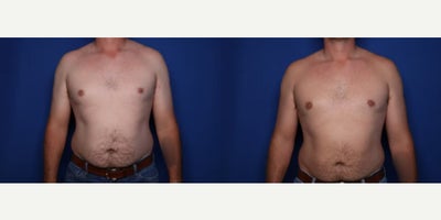 31 year old man treated with Gynecomastia Surgery - 31 year old male who developed gynecomastia after testosterone use. He is shown 3 months after a bilateral gynecomastectomy (male breast reduction).
